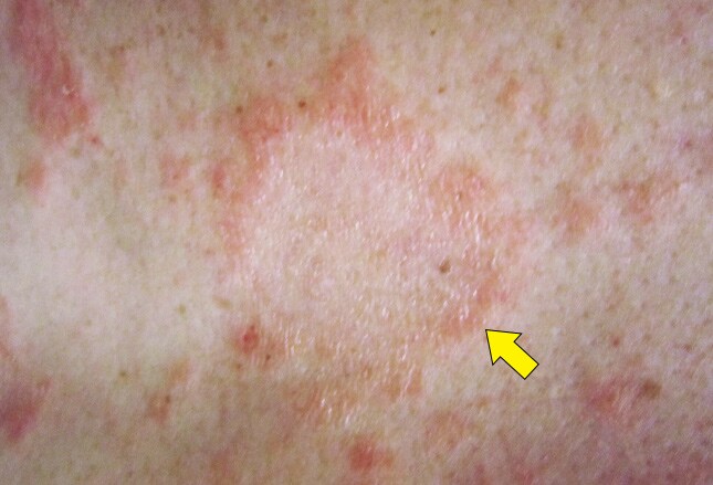 14 Rashes You Need To Know Common Dermatologic Diagnoses