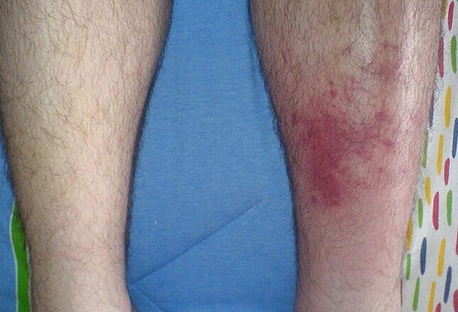 Ffm anal stories Pictures of bikini line infections