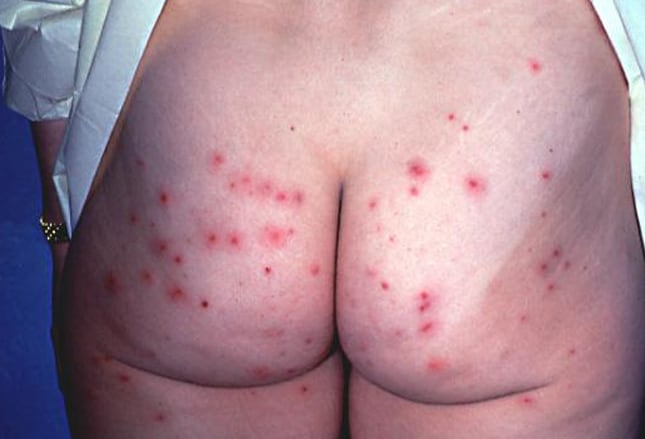 Skin Rash On Butt 30