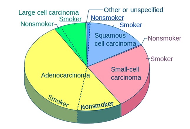 Lung cancer echart Full illustrated