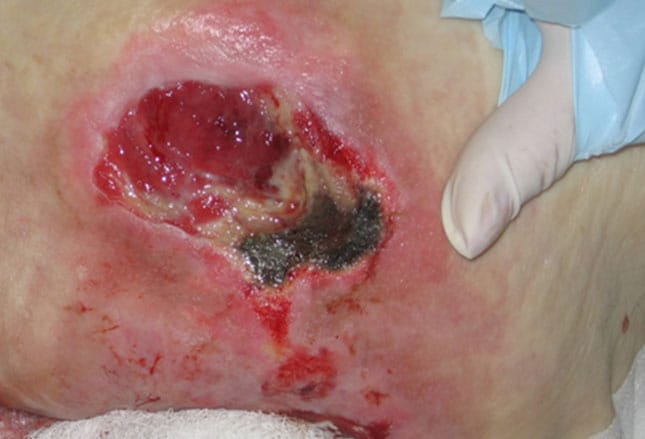 pictures of pressure ulcers