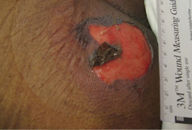 pressure ulcers Also known as pressure ulcers and pressure sores, bed sores can happen when there is friction or unrelieved pressure on one part of the body. pressure ulcers Also known as pressure ulcers and pressure sores, bed sores can happen when there is friction or unrelieved pressure on one part of the body.