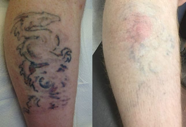 Tattoo Skin Reactions: Allergies and Infections
