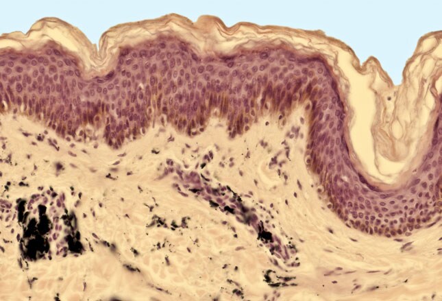 tattoo skin reactions allergies and infections tattoo skin reactions allergies and infections