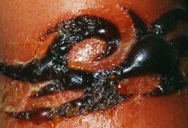 16 henna tattoo allergic reaction dangers of using black 16 henna tattoo allergic reaction dangers of using black