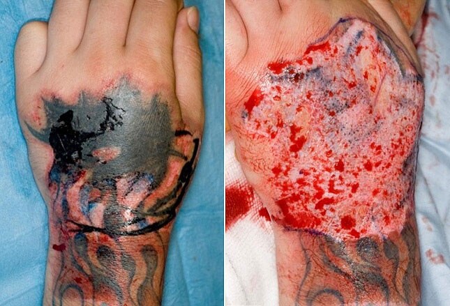 black ink infected tattoo