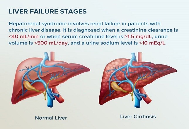 liver failure stages the top 10 clinical trends of 2016 liver failure stages the top 10 clinical trends of 2016