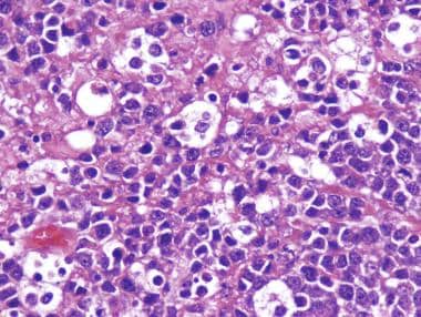 Large cell medulloblastoma with large vesicular nu