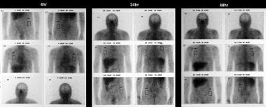 Sarcoidosis, thoracic. Gallium-67 scans in a patie