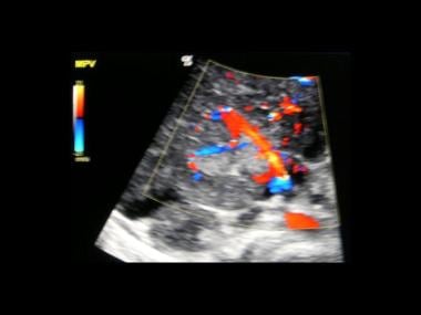 Color Doppler ultrasonography depicts a vasculariz