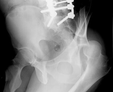 Posterior column acetabular fracture. Compared wit