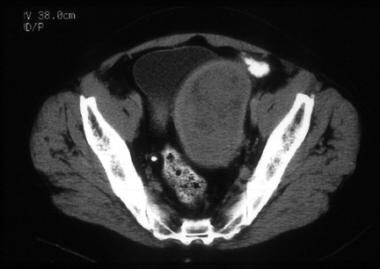 A 64-year-old woman with poorly differentiated end