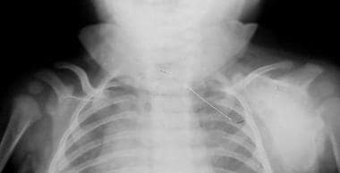 Frontal view shows deformity of the left scapula, 