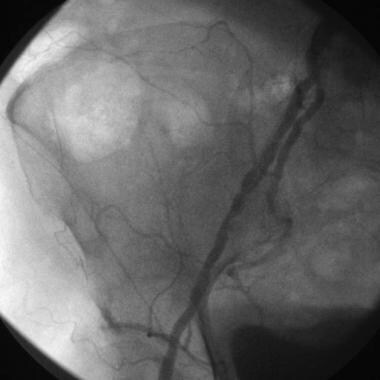 Preangioplasty left superficial femoral artery ang