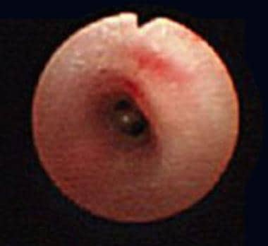 Normal airway color and architecture (in a child w