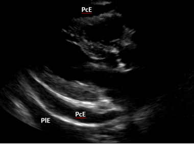 Ultrasound image of a pericardial effusion (PcE) i