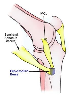 Location of anserine (pes anserinus) bursa on medi