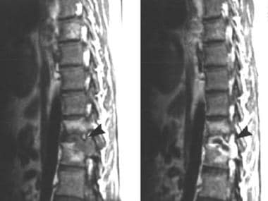 MRI of a 31-year-old man with tuberculosis of the 