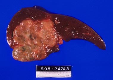 Fibrolamellar carcinoma: Note the large tumor size