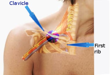 Figure shows area where subclavian vein is obstruc