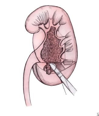 Positioning of nephrostomy tube into the lower pol