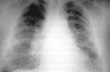 Chest radiograph of a 36-year-old chemical worker 