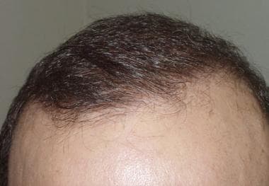 Case 2. Close-up view of the hairline of a patient