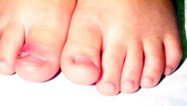 Right great toe paronychia in a 3-year-old child. 