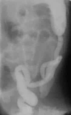 distended stomach in diabetic coma x ray