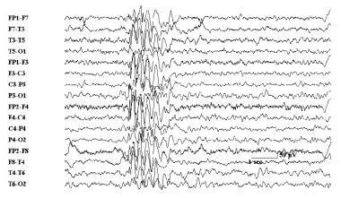 Electroencephalogram demonstrating polyspike and w