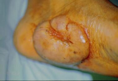 Keloid located on the foot. The initial injury was