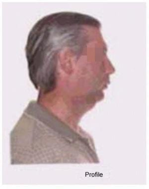 Breathing-related sleep disorder. Significant retr