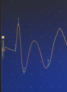 Sensory nerve action potential. 