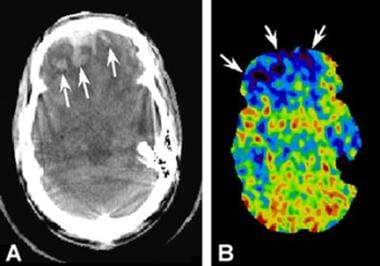 Comparison of a CT scan with a xenon blood-flow ra