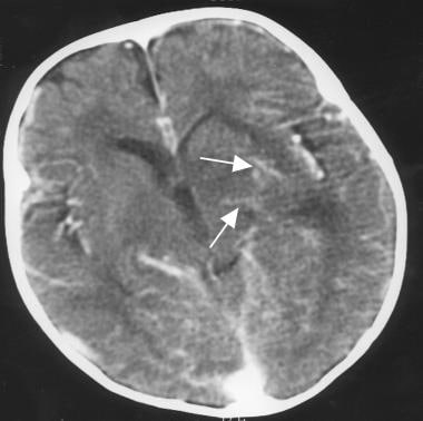 Cerebritis and developing abscess formation in a p