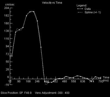 Aortic velocity vs time plot from the phase contra