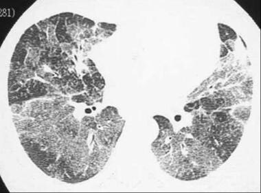 High-resolution CT (HRCT) shows rapid changes asso