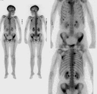 What are normal and abnormal bone scan results?