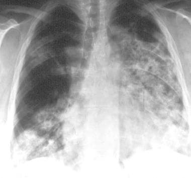 Granulomatosis with polyangiitis (GPA), thoracic. 