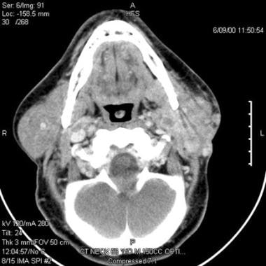 Parotid, malignant tumors. CT scan shows a carcino