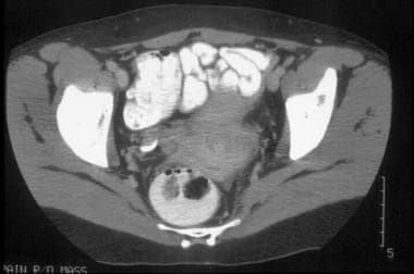CT of clinical stage IIB cervical carcinoma. Param