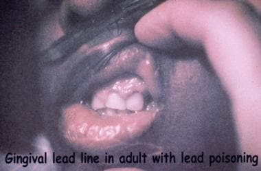 Lead line on the gingival border of an adult with 