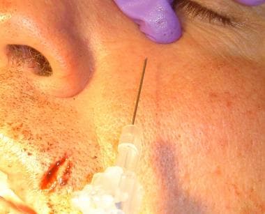 Technique for extraoral infraorbital nerve block. 