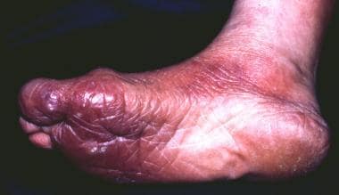 A 73-year-old female farmer with a cutaneous plaqu