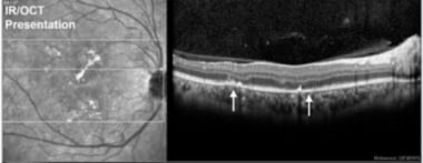 Note the disruption of RPE/outer retina that corre