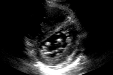 Ultrasound image of a dilated right ventricle resu