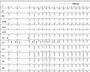Atrial tachycardia. This 12-lead electrocardiogram