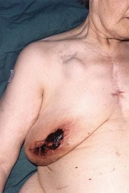 Wound infection due to disturbed coagulopathy. Thi