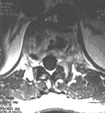 MRI of the T11 in a 31-year-old man with tuberculo