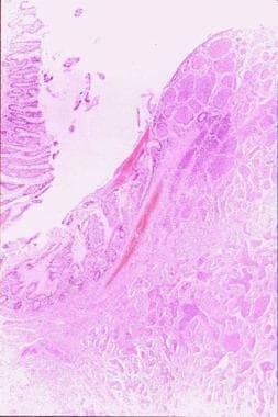 A section (on the right) of an intestinal carcinoi